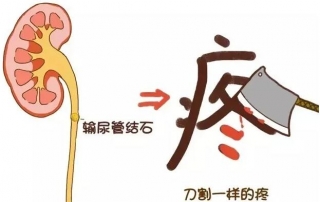 高溫熱浪催動結石大爆發(fā)，一患者因結石長期梗阻致輸尿管破裂